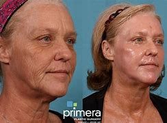 Image before and after deep peel