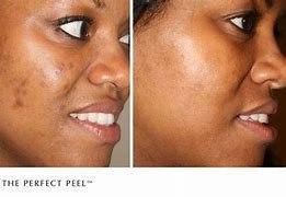 Image before and after light peel