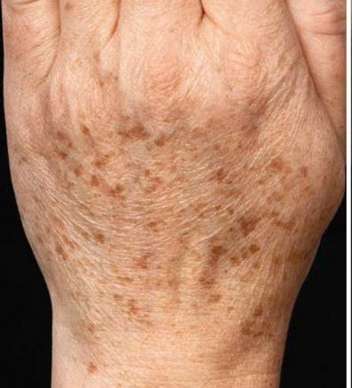 image of hand with age spots